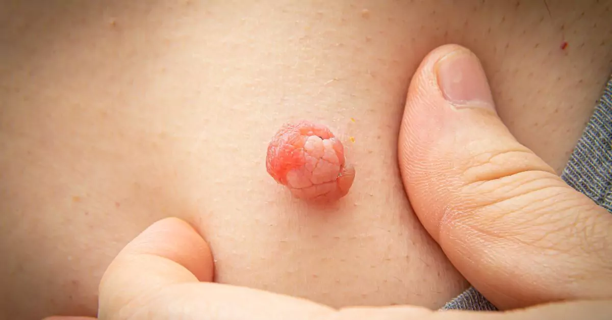 How to remove skin tags naturally at home