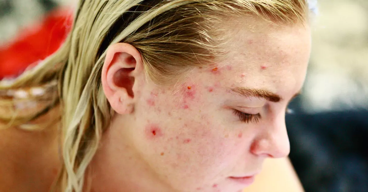 How to Get Rid of Acne