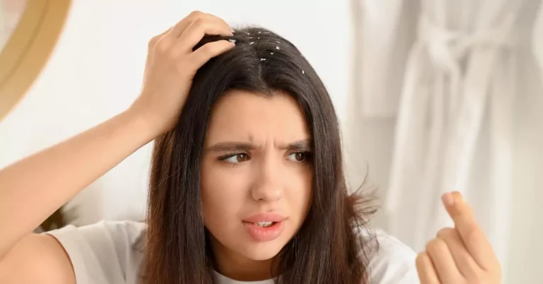 how to get rid of dandruff