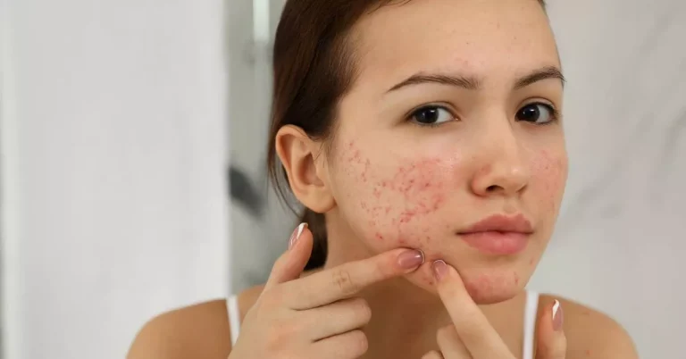 How to Get Rid of Pimples Overnight